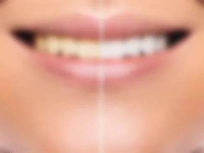 whiten my teeth by valentina-vegas